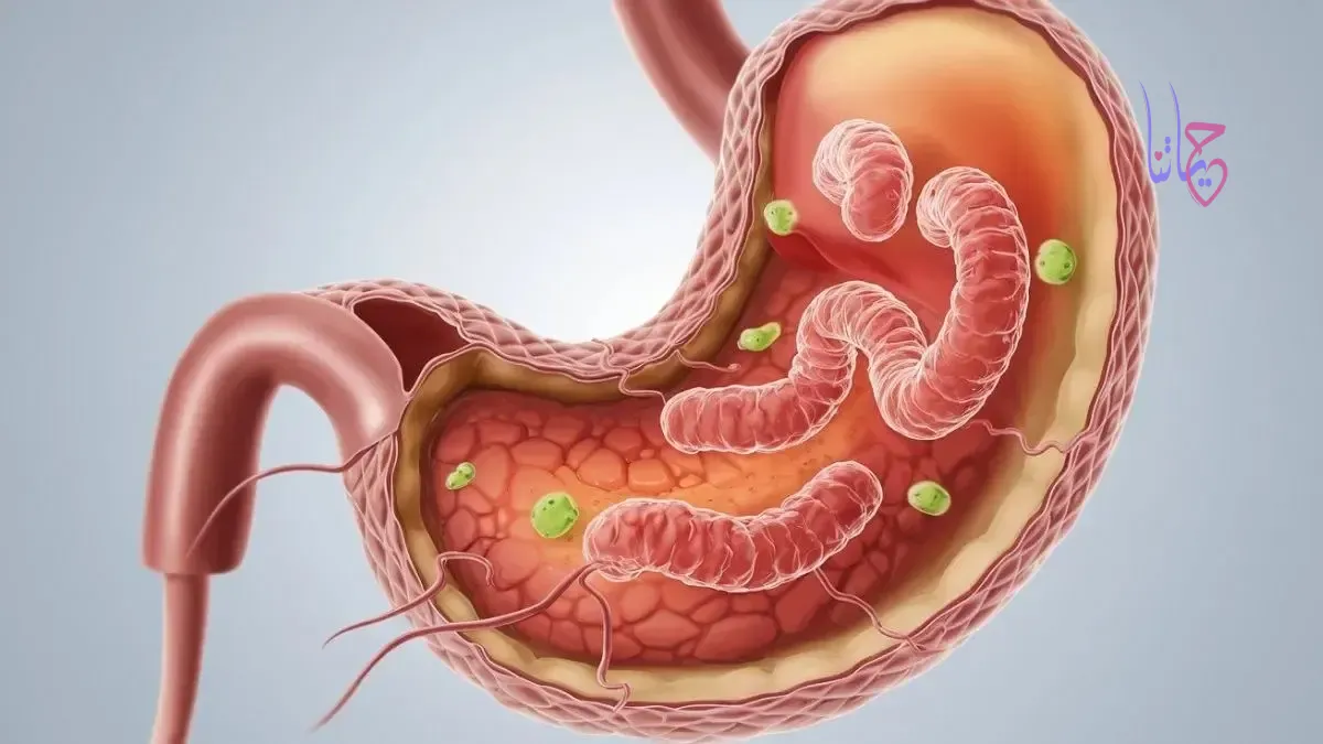 علاج جرثومة المعدة